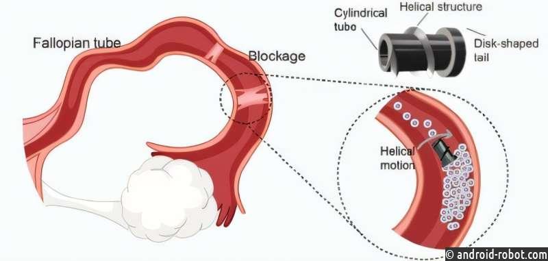 Роботизированные микровинты с магнитным приводом предлагают новое решение для лечения непроходимости маточных труб